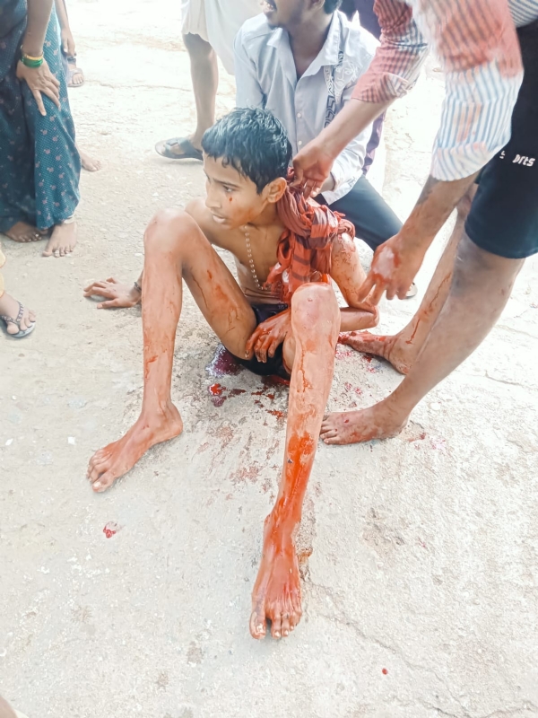 ಕಂಪ್ಲಿ: ಮೊಸಳೆ ದಾಳಿಗೆ ಗಾಯಗೊಂಡ ಬಾಲಕ